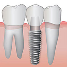 dental-implants-1.jpg