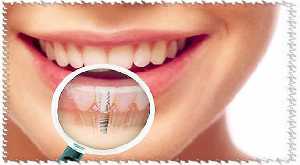 Зубные имплантаты: можно или нельзя?