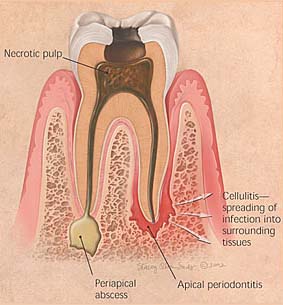 periodontitisl-2.jpg