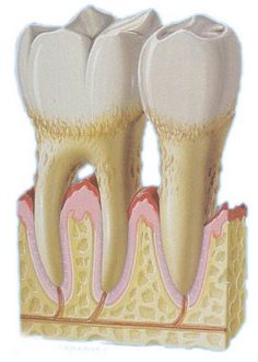 periodontitisl.jpg