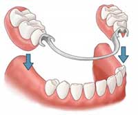 removable-dental-proteses-4.jpg