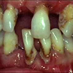 periodontitis-final.jpg